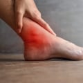 The Foot Doctor's Guide To Recognizing And Treating Charcot Foot Stages