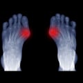 Why Podiatrists are the Best Choice for Bunion Surgery