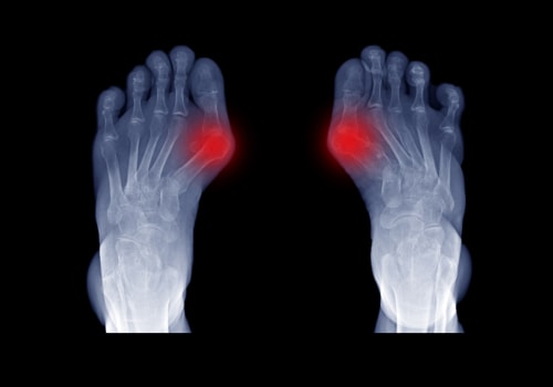 Why Podiatrists are the Best Choice for Bunion Surgery