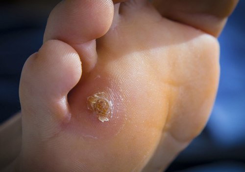 Expert Tips for Treating Common Foot Problems